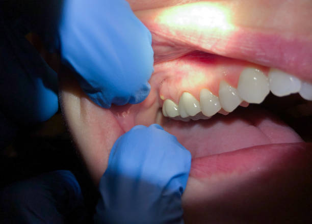 Best Emergency Treatment for Dental Infections or Abscesses in Loretto, PA